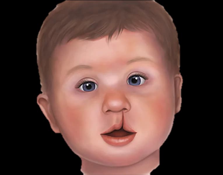 Cleft Lip & Palate Care