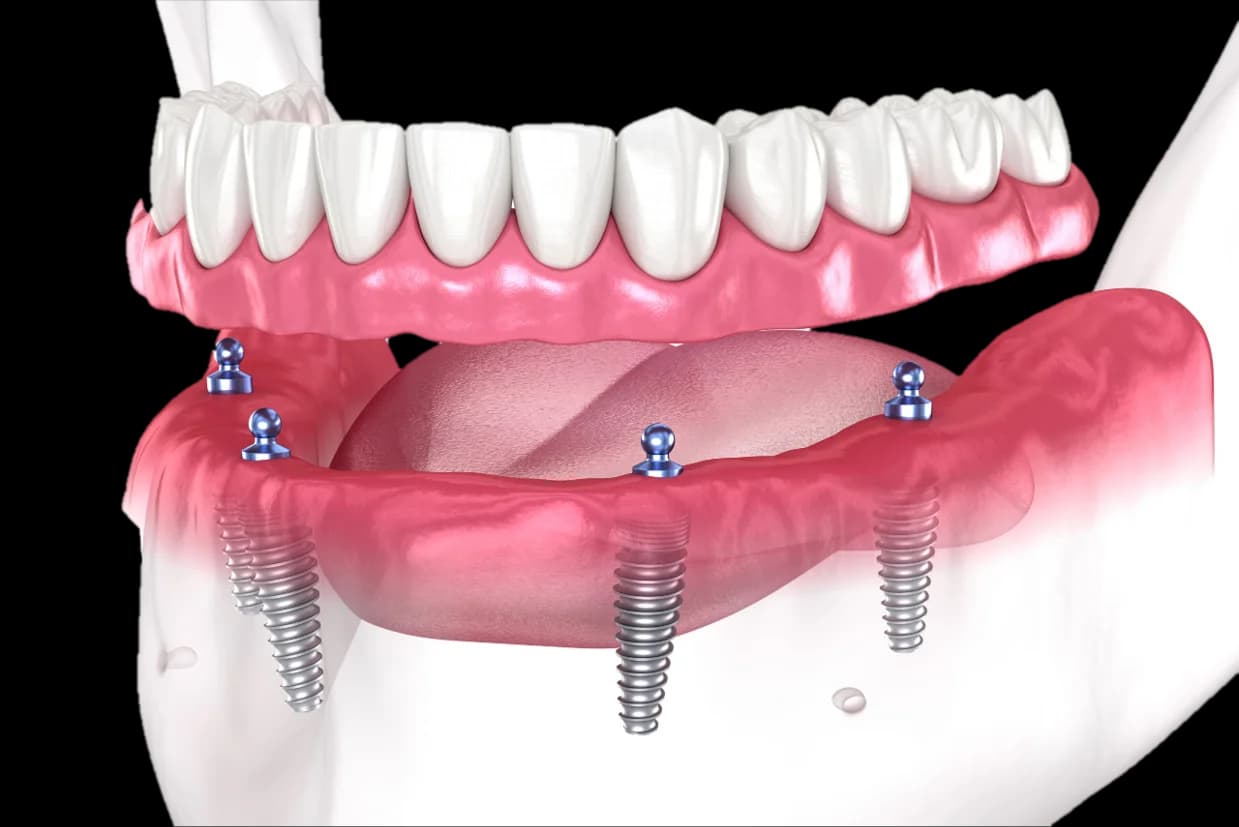 Full Mouth Rehabilitation