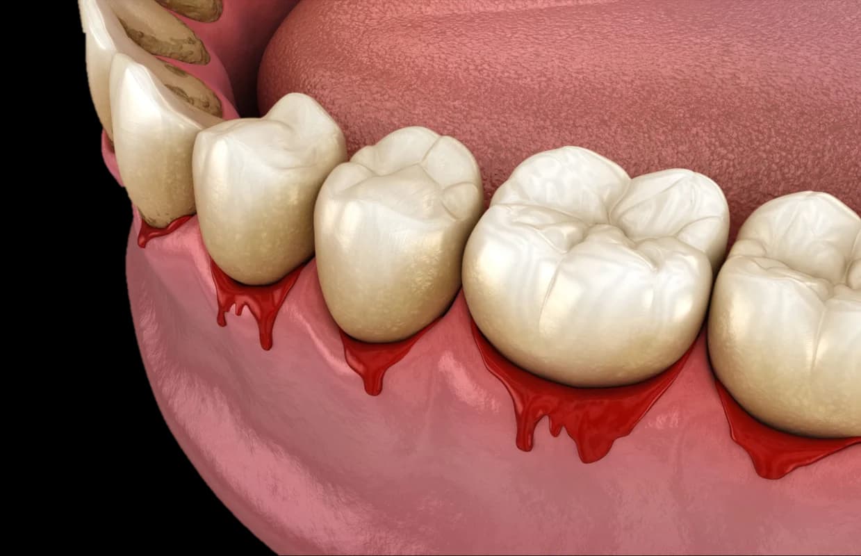 Gum Disease Treatment Hyderabad