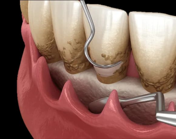 Guided Biofilm Therapy