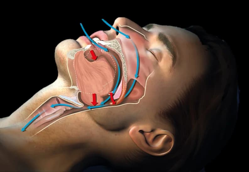 Sleep Apnea Dentistry