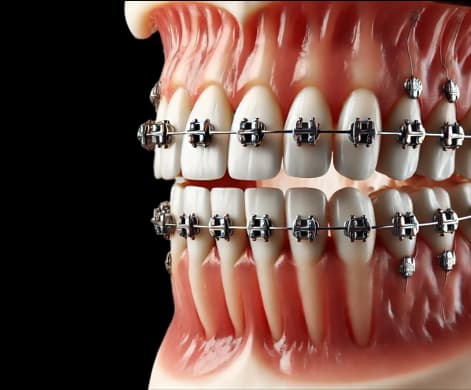 Orthodontic Retainers