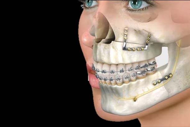 Orthognathic Surgery Hyderabad